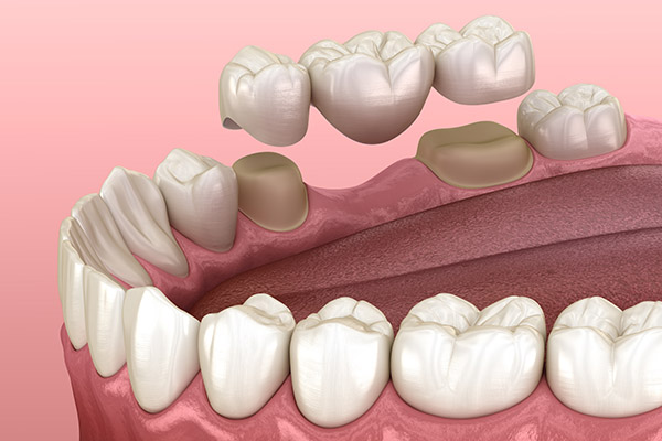 Dental Bridge Options for Replacing Missing Teeth from Miami Beach Smiles in Miami Beach, FL