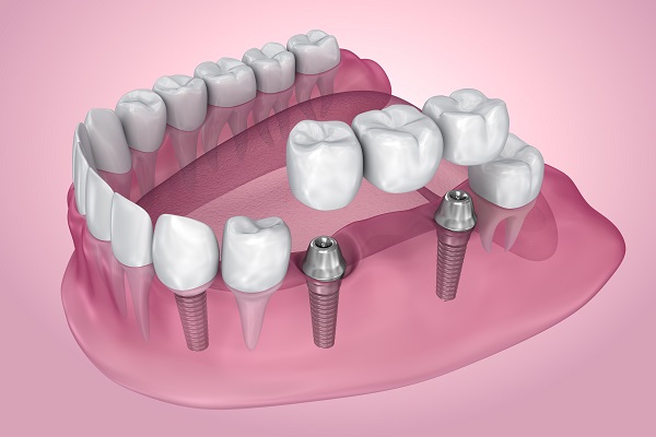 Benefits Of Dental Bridges