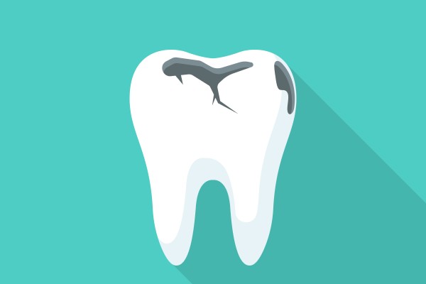 What Materials Are Used In A Dental Filling?