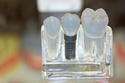 Getting A Dental Implant Restoration From Miami Beach Smiles