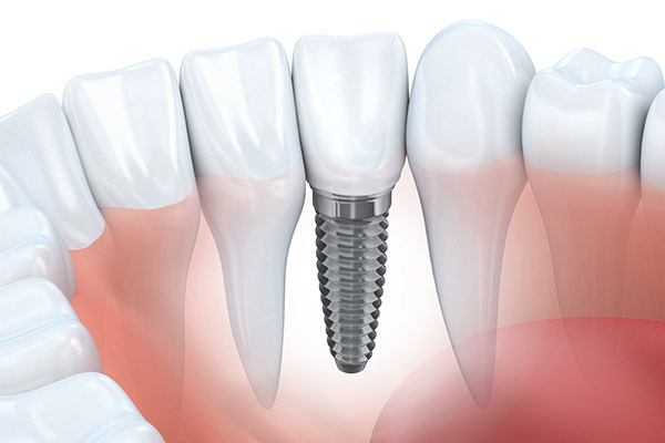 An Implant is a New Tooth Root Option for Replacing a Missing Tooth  from Miami Beach Smiles in Miami Beach, FL