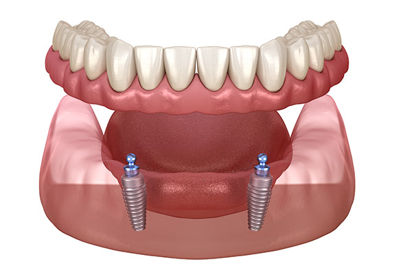 Implant Overdenture Options for Replacing Missing Teeth from Miami Beach Smiles in Miami Beach, FL
