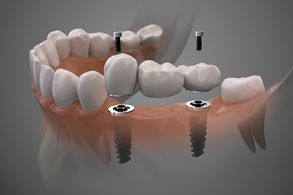 Implant Supported Full Bridge - An Option for Replacing Missing Teeth from Miami Beach Smiles in Miami Beach, FL