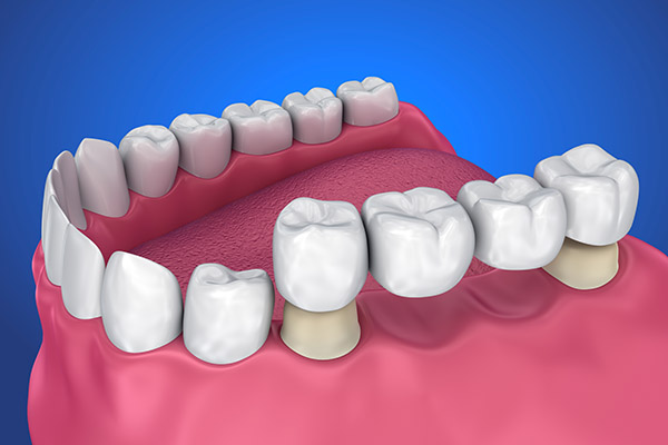 Options for the Replacement of Multiple Missing Teeth from Miami Beach Smiles in Miami Beach, FL
