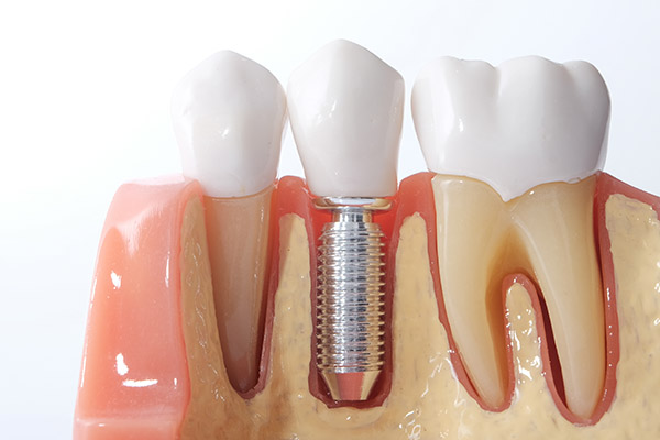 Options For Replacing A Single Missing Tooth