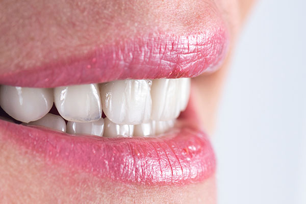 How To Prevent Cavities Under Veneers from Miami Beach Smiles in Miami Beach, FL