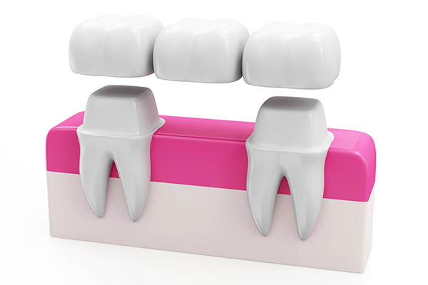 Why Choose a Bridge Option to Replace Missing Teeth from Miami Beach Smiles in Miami Beach, FL